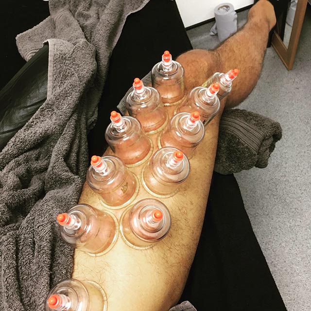 Myofascial cupping on the thigh